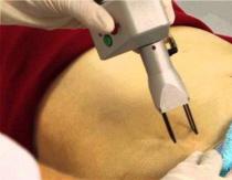 Як прибрати розтяжки після пологів на животі за допомогою кремів та процедур