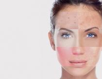 Si të përcaktoni saktë llojin e lëkurës suaj të fytyrës Çfarë lloji të testit të lëkurës së fytyrës
