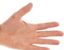 हाथों की त्वचा के छिलने, शुष्क होने और फटने के कारण और उपचार